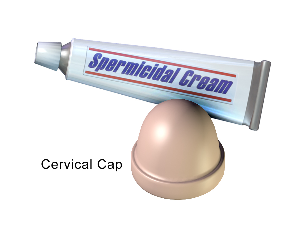 A squeeze tube of spermicide cream next to a cervical cap