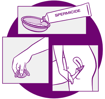 Spermicide goes in the dome of the diaphragm and is spread around the rim. The diaphragm is folded and put in the vagina with your fingers.