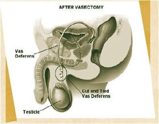 An inside view of the penis showing a cut and tied vas deferens