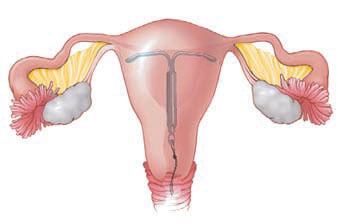 A uterus with an IUD inside