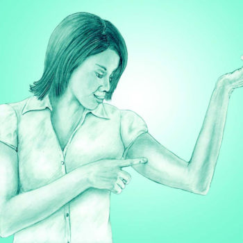 A woman points to the place in her upper arm where the implant is inserted